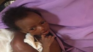 Six-months old Aisha Bilya looks frail and skeletal; she has very low weight for her height and clearly appears to be suffering from severe muscle wasting