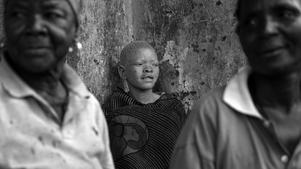 Amnesty International say systematic failures have emboldened killers as attacks on people with albinism continue.